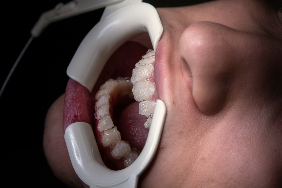 Close-up of endodontic root canal dental treatment in progress
