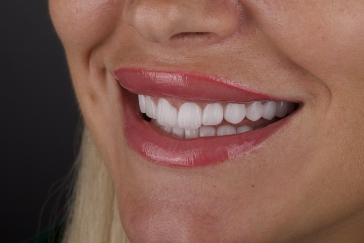 Smile Case 10 image 2