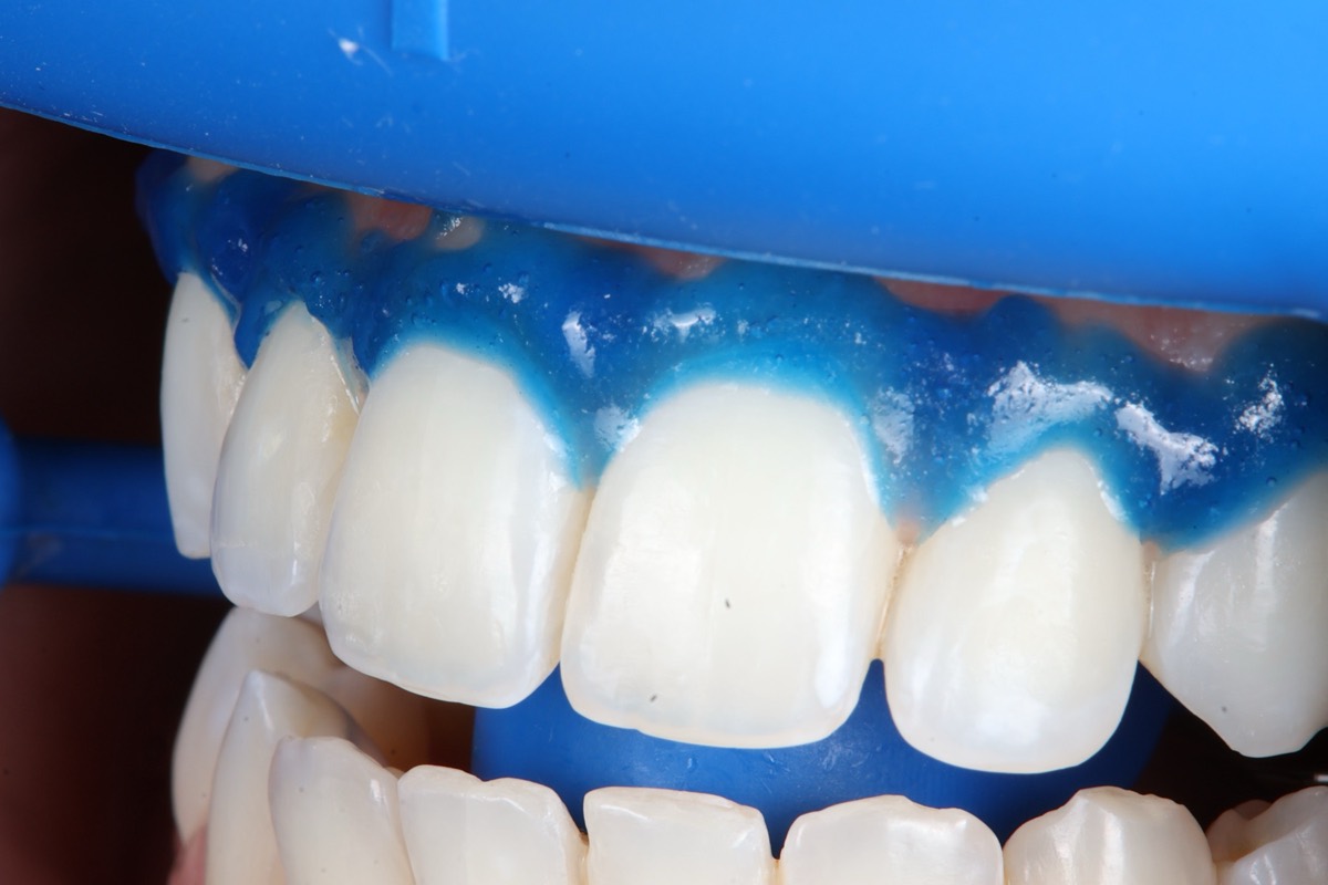 Smile Case 2 image 5