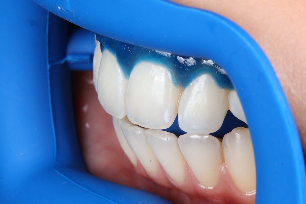 Smile Case 2 image 6